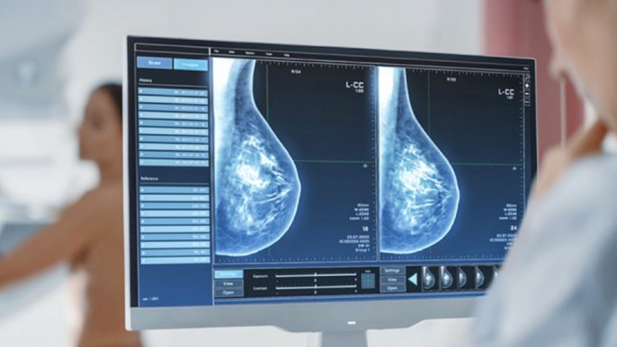 Nuevo test de saliva que detecta cáncer de mama en tan solo 5 segundos por 5 euros
